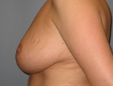 Patient # 27515 After Photo # 6